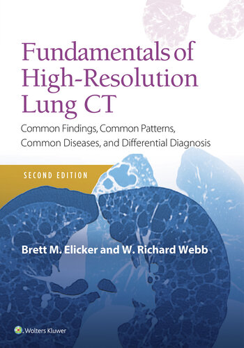 Fundamentals of High-Resolution Lung CT: Common Findings, Common Patterns, Common Diseases and Differential Diagnosis