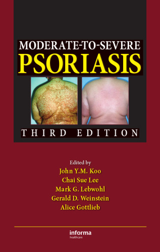 Moderate-to-Severe Psoriasis, Third Edition
