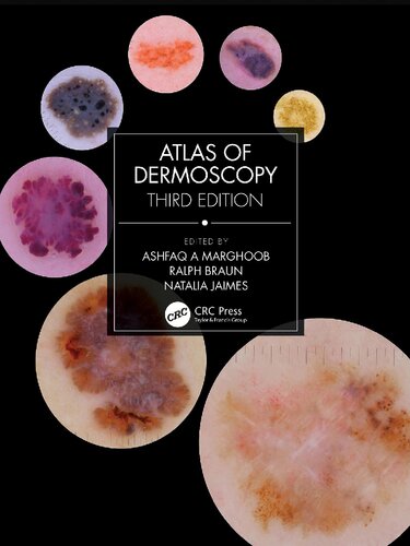 Atlas of Dermoscopy: