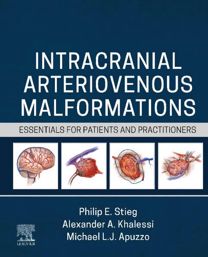 Intracranial Arteriovenous Malformations: Essentials for Patients and Practitioners