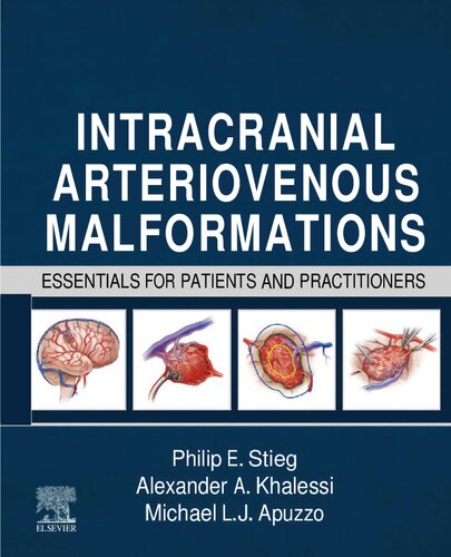 Intracranial Arteriovenous Malformations: Essentials for Patients and Practitioners