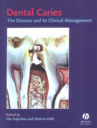 Dental Caries: The Disease and Its Clinical Management