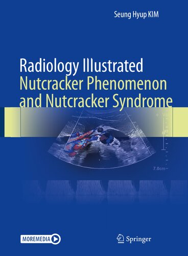 Radiology Illustrated: Nutcracker Phenomenon and Nutcracker Syndrome
