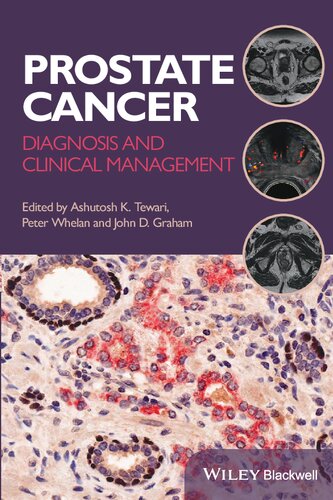 Prostate Cancer: Diagnosis and Clinical Management