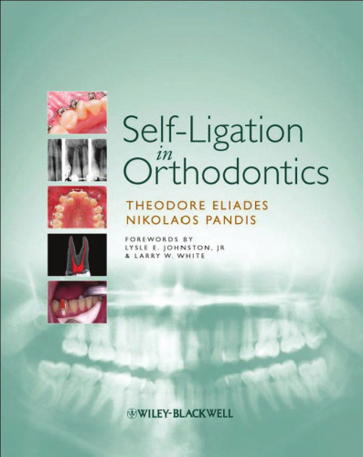 Self-Ligation in Orthodontics