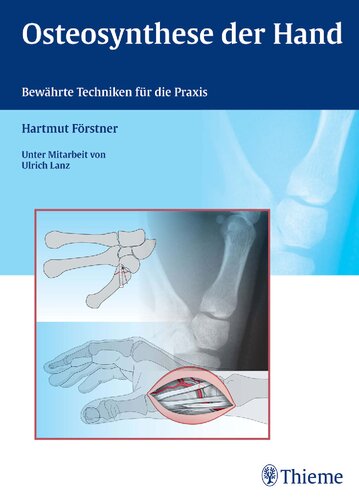 Osteosynthese der Hand