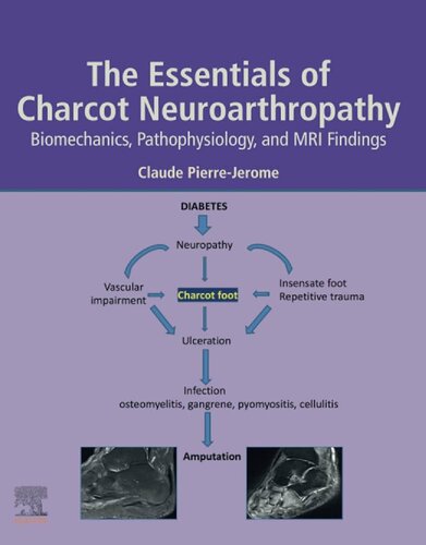The Essentials of Charcot Neuroarthropathy: Biomechanics, Pathophysiology, and MRI Findings