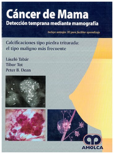 Cáncer de Mama. Detección temprana mediante mamografía