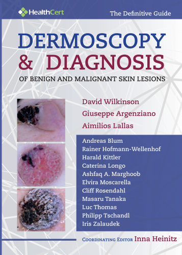 Dermoscopy & Diagnosis of Benign and Malignant Skin Lesions