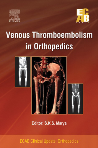 Venous Thromboembolism in Orthopedics - ECAB