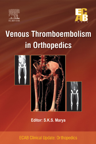 Venous Thromboembolism in Orthopedics - ECAB