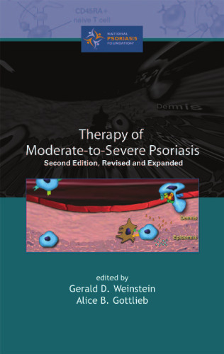 Therapy of Moderate-to-Severe-Psoriasis, Second Edition,