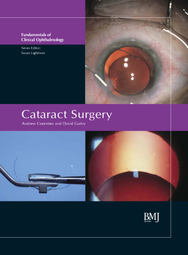 Cataract Surgery: FCO Series
