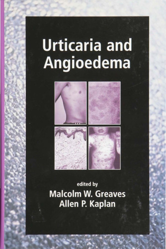 Urticaria and Angioedema