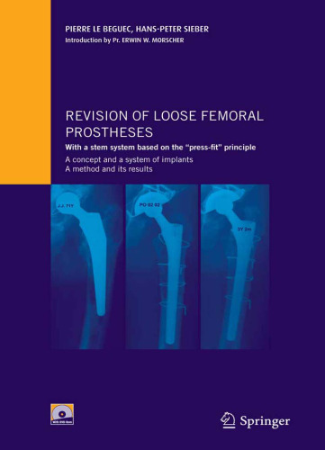 Revision of loose femoral prostheses with a modular stem system basing on the 'press-fit' principle