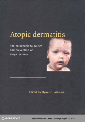 Atopic Dermatitis: The Epidemiology, Causes and Prevention of Atopic Eczema