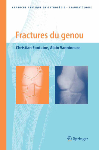 Fractures du genou (Approche pratique en orthopedie-traumatologie)