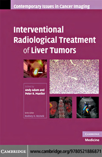 Interventional Radiological Treatment of Liver Tumors (Contemporary Issues in Cancer Imaging)