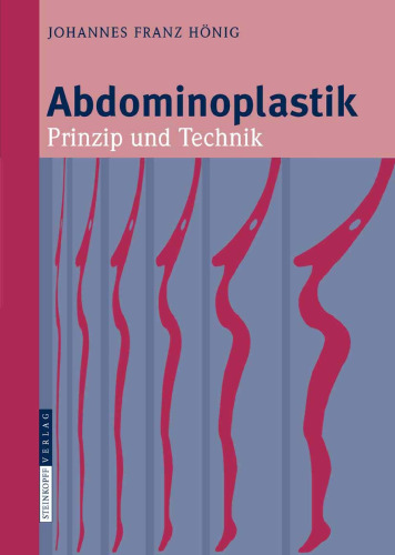 Abdominoplastik: Prinzip und Technik (German Edition)