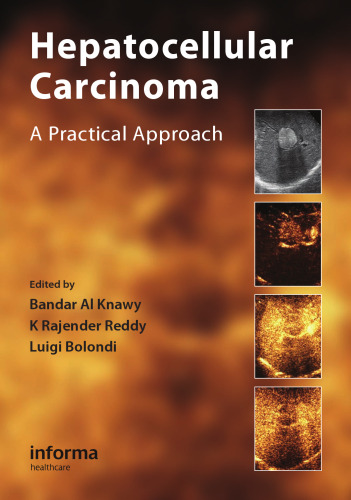 Hepatocellular Carcinoma: A Practical Approach