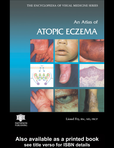 An Atlas of Atopic Eczema (Encyclopedia of Visual Medicine Series)
