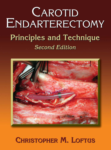 Carotid Endarterectomy: Principles and Technique, Second Edition