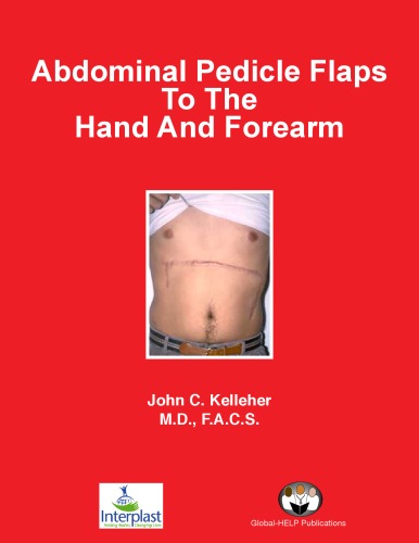 Abdominal Pedicle Flaps To The Hand & Forearm