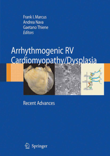 Arrhythmogenic right ventricular cardiomyopathy dysplasia: Recent Advances