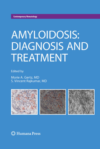 Amyloidosis: Diagnosis and Treatment