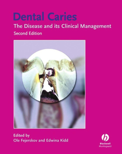 Dental caries: The disease and its clinical management