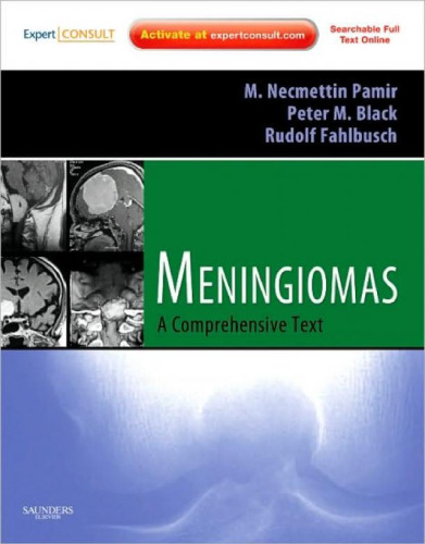 Meningiomas: Expert Consult - Online and Print (Expert Consult Title: Online + Print)