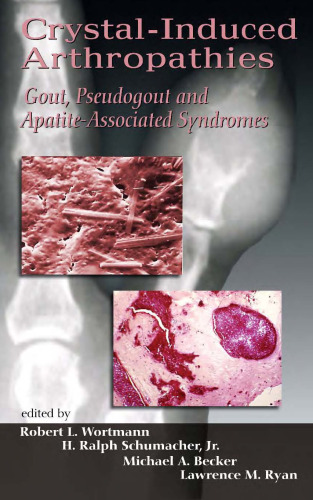 Crystal-Induced Arthropathies: Gout, Pseudogout and Apatite-Associated Syndromes