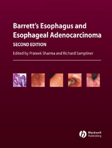 Barrett's Esophagus and Esophageal Adenocarcinoma (Second Edition)