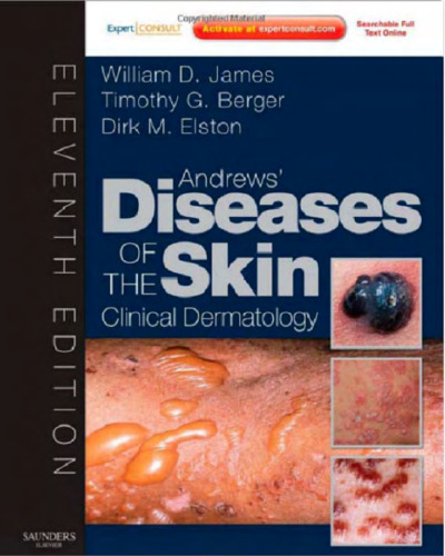 Andrews' Diseases of the Skin: Clinical Dermatology - Expert Consult - Online and Print (James, Andrew's Disease of the Skin), 11th Edition