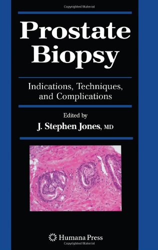 Prostate Biopsy: Indications, Techniques, and Complications