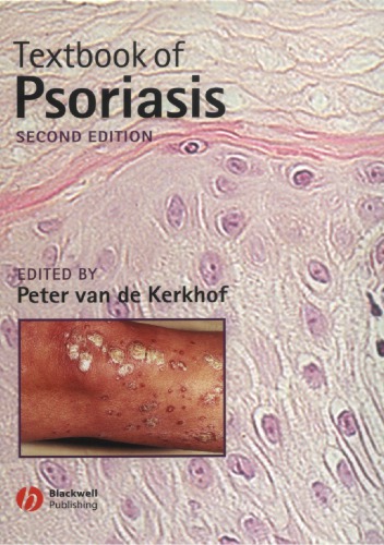 Textbook of psoriasis