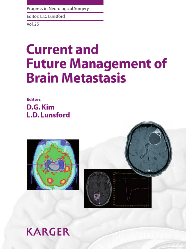 Current and Future Management of Brain Metastasis